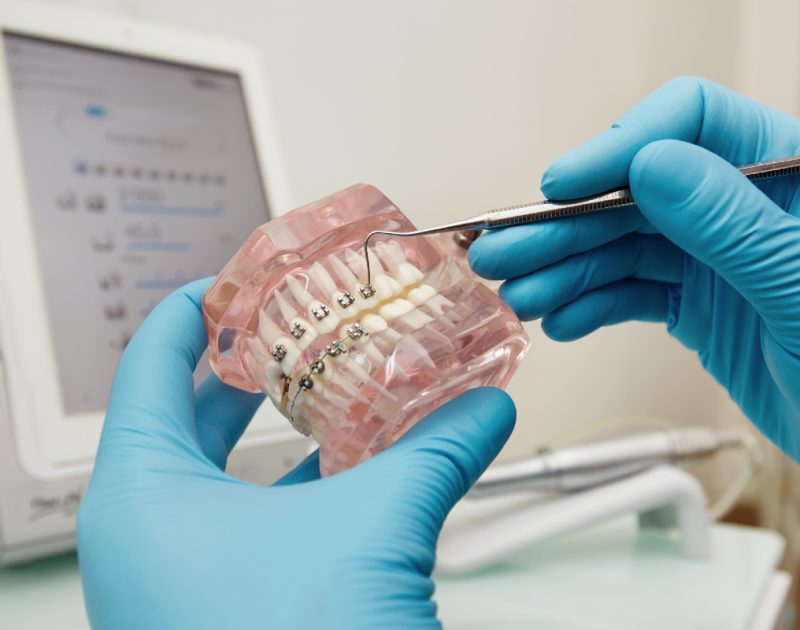 dentist holding jaw model with fixed braces attached