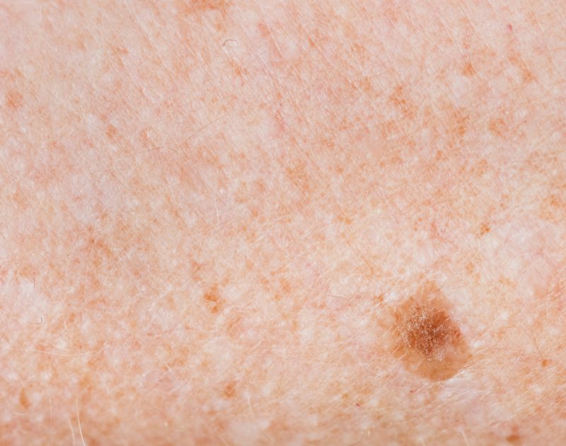 close up of freckle on skin